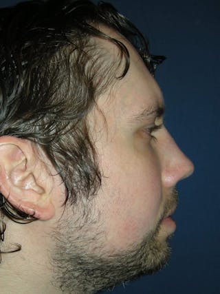 Rhinoplasty by Dr. Haydon Before & After Gallery - Patient 55455315 - Image 4