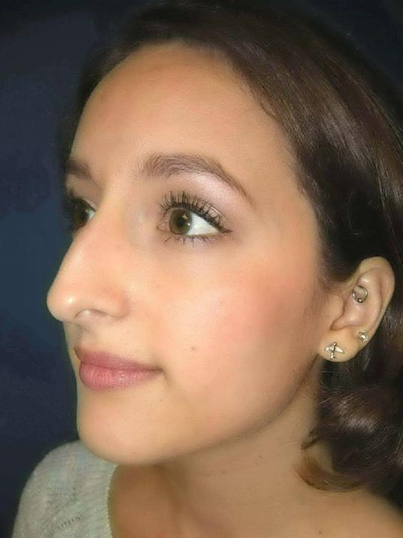 Rhinoplasty by Dr. Haydon Before & After Gallery - Patient 55455317 - Image 3