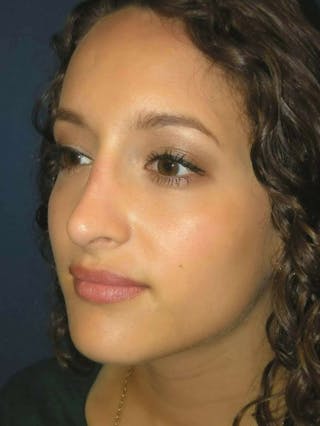 Rhinoplasty by Dr. Haydon Before & After Gallery - Patient 55455317 - Image 4