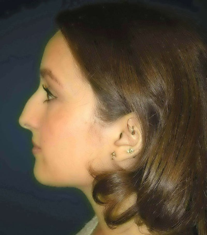 Rhinoplasty by Dr. Haydon Before & After Gallery - Patient 55455317 - Image 5