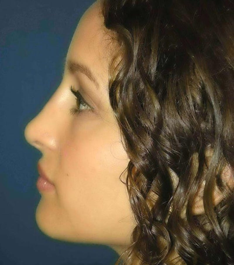 Rhinoplasty by Dr. Haydon Before & After Gallery - Patient 55455317 - Image 6
