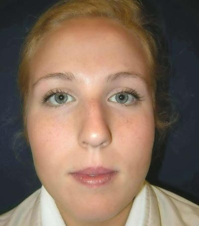 Rhinoplasty by Dr. Haydon Before & After Gallery - Patient 55455324 - Image 1