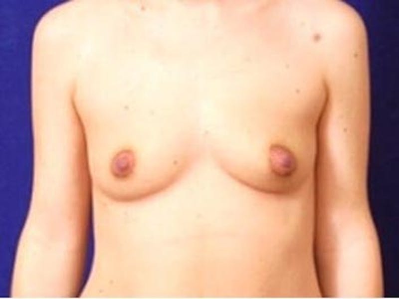 Breast Augmentation by Dr. Wilder Before & After Gallery - Patient 55455323 - Image 1