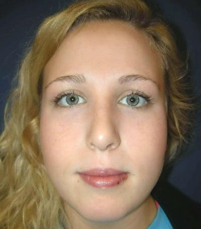 Rhinoplasty by Dr. Haydon Before & After Gallery - Patient 55455324 - Image 2