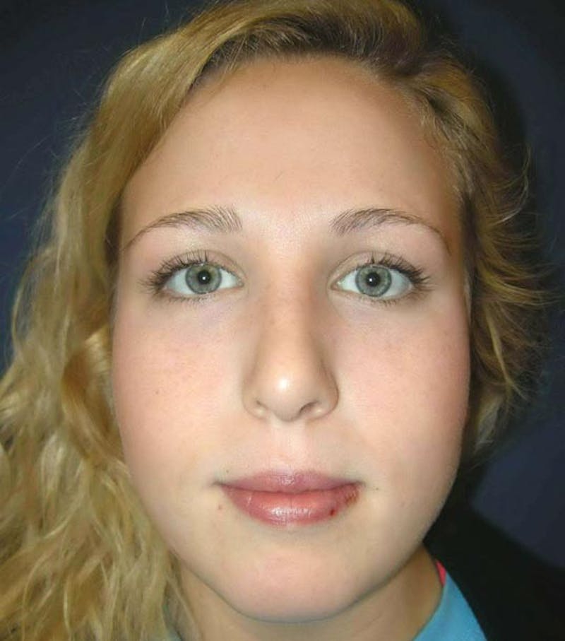 Rhinoplasty by Dr. Haydon Gallery - Patient 55455324 - Image 2