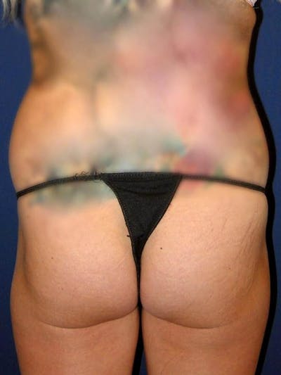 Fat Transfer by Dr. Haydon Gallery - Patient 55455328 - Image 1