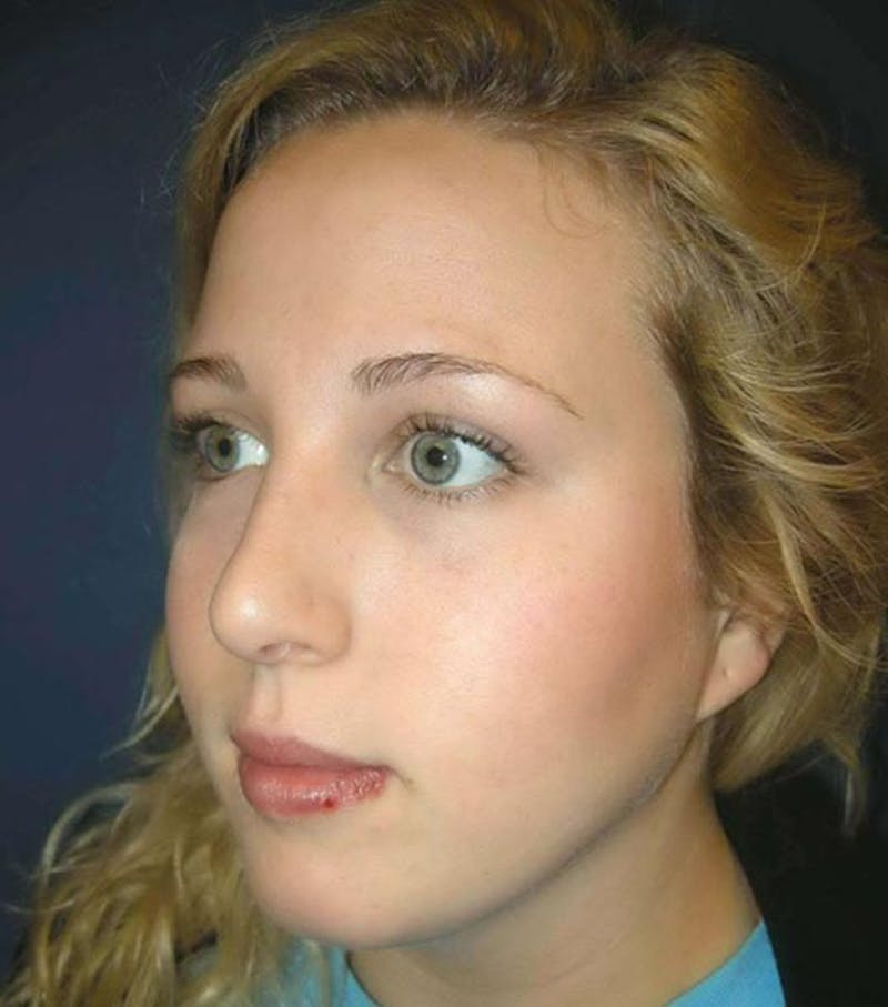 Rhinoplasty by Dr. Haydon Before & After Gallery - Patient 55455324 - Image 4