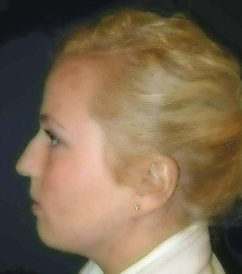 Rhinoplasty by Dr. Haydon Before & After Gallery - Patient 55455324 - Image 5