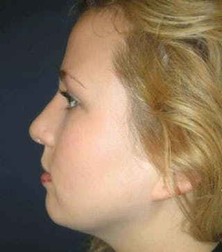 Rhinoplasty by Dr. Haydon Before & After Gallery - Patient 55455324 - Image 6