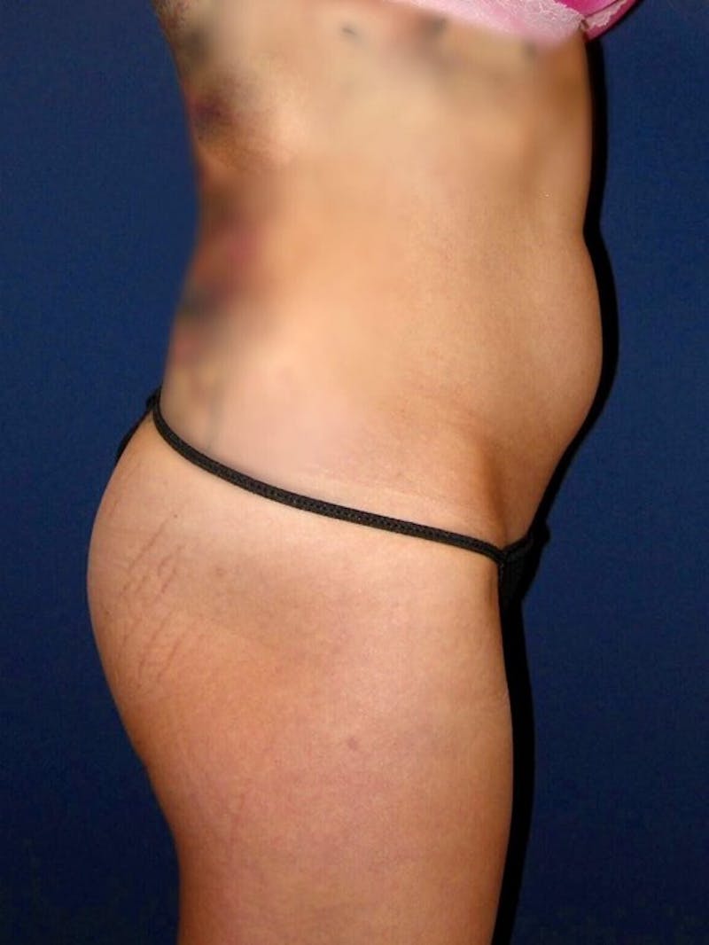 Fat Transfer by Dr. Haydon Before & After Gallery - Patient 55455328 - Image 5