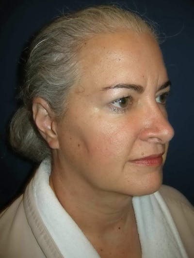 Rhinoplasty by Dr. Haydon Before & After Gallery - Patient 55455330 - Image 2