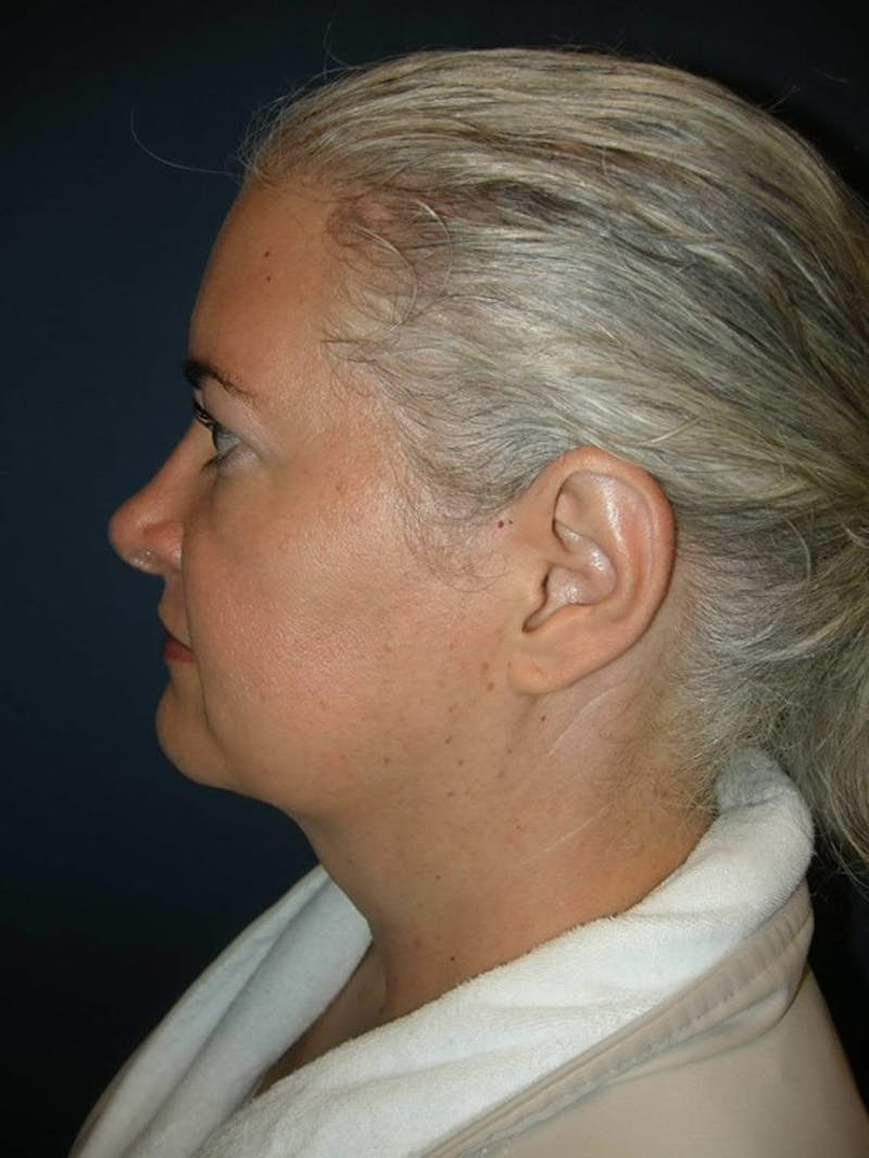 Rhinoplasty by Dr. Haydon Before & After Gallery - Patient 55455330 - Image 4