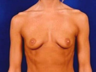 Breast Augmentation by Dr. Wilder Before & After Gallery - Patient 55455331 - Image 1