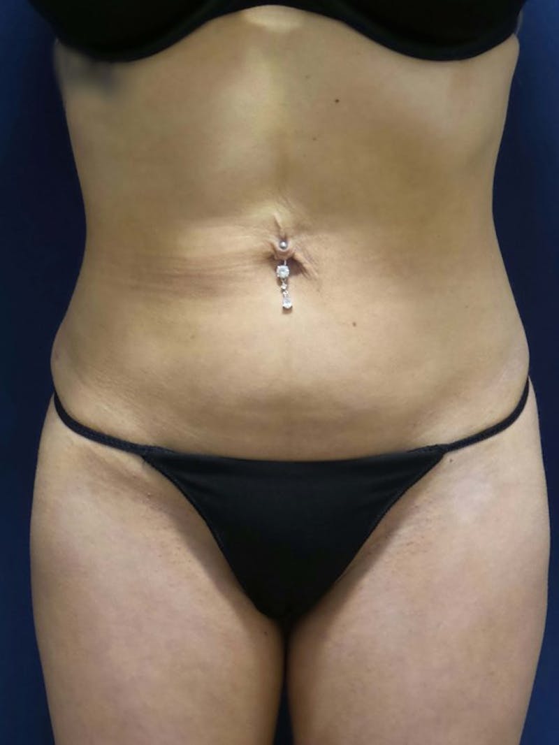 Fat Transfer by Dr. Haydon Gallery - Patient 55455328 - Image 8