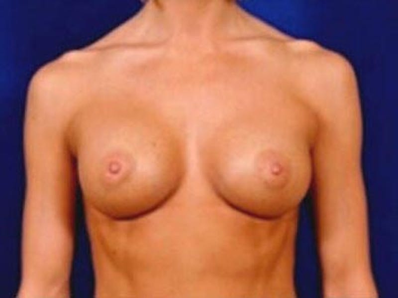 Breast Augmentation by Dr. Wilder Before & After Gallery - Patient 55455331 - Image 2