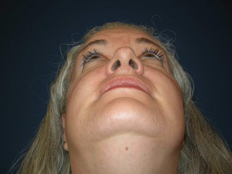 Rhinoplasty by Dr. Haydon Before & After Gallery - Patient 55455330 - Image 5