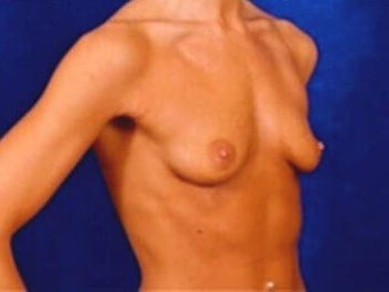 Breast Augmentation by Dr. Wilder Before & After Gallery - Patient 55455331 - Image 3