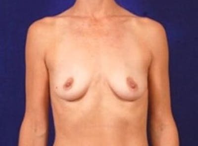 Breast Augmentation by Dr. Wilder Before & After Gallery - Patient 55455336 - Image 1