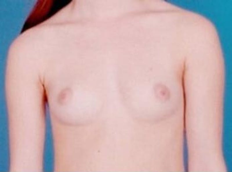 Breast Augmentation by Dr. Wilder Before & After Gallery - Patient 55455338 - Image 1