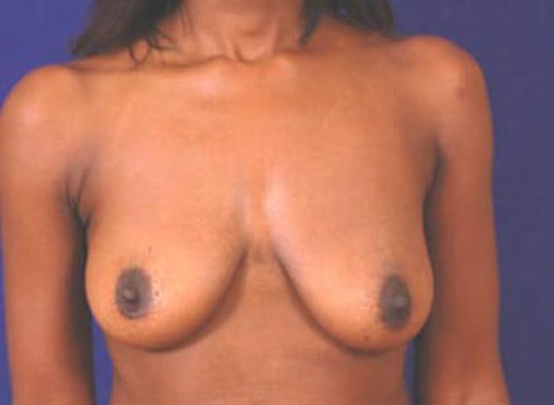 Breast Lift by Dr. Wilder Before & After Gallery - Patient 55455341 - Image 1