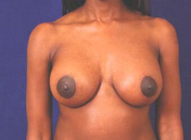 Breast Lift by Dr. Wilder Before & After Gallery - Patient 55455341 - Image 2
