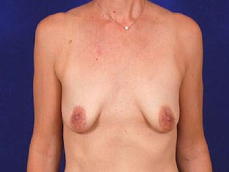 Breast Augmentation by Dr. Wilder Before & After Gallery - Patient 55455342 - Image 1