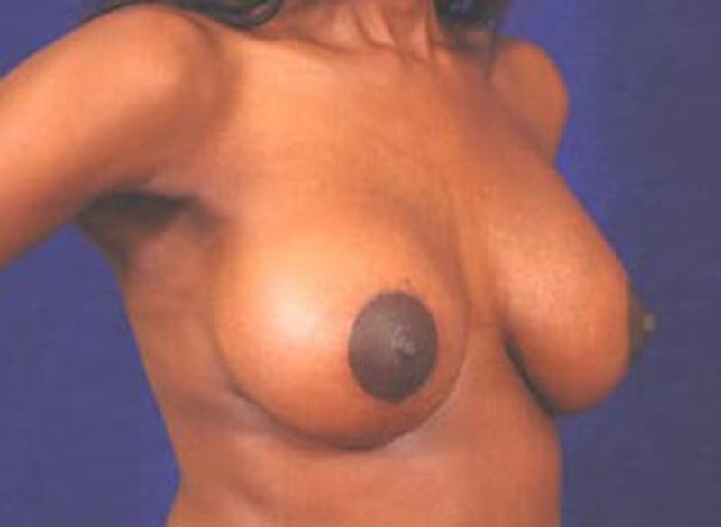 Breast Lift by Dr. Wilder Before & After Gallery - Patient 55455341 - Image 4