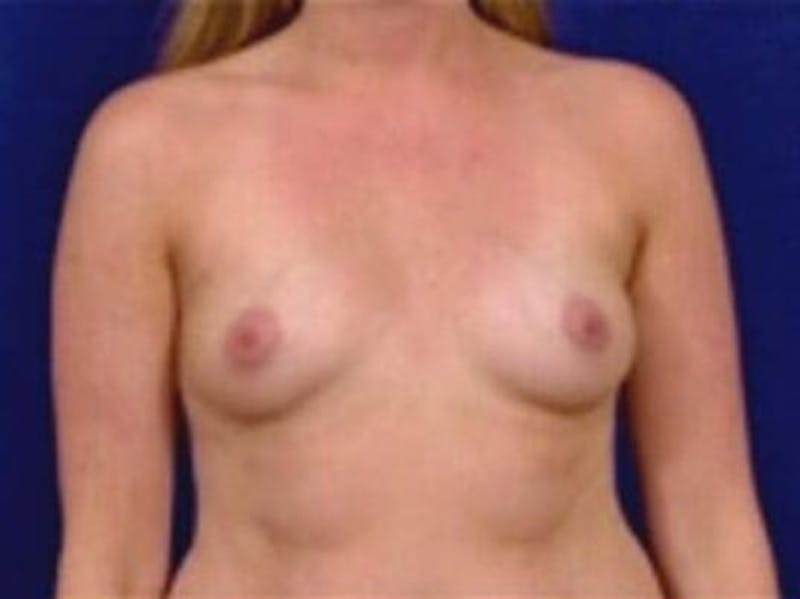 Breast Augmentation by Dr. Wilder Before & After Gallery - Patient 55455350 - Image 1