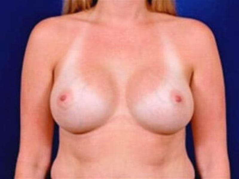 Breast Augmentation by Dr. Wilder Before & After Gallery - Patient 55455350 - Image 2