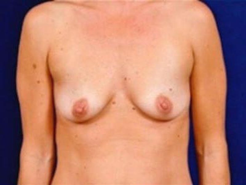 Breast Augmentation by Dr. Wilder Before & After Gallery - Patient 55455352 - Image 1