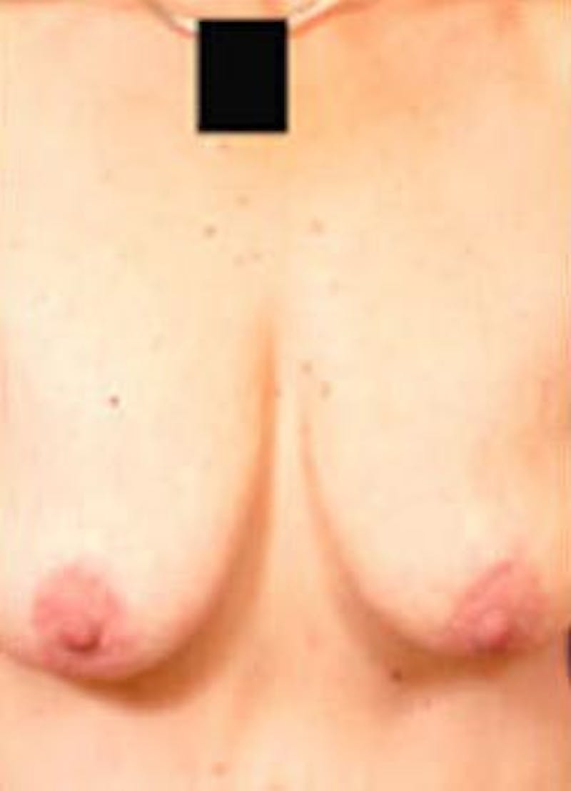 Breast Lift by Dr. Wilder Before & After Gallery - Patient 55455355 - Image 1