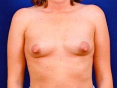 Breast Augmentation by Dr. Wilder Before & After Gallery - Patient 55455354 - Image 1