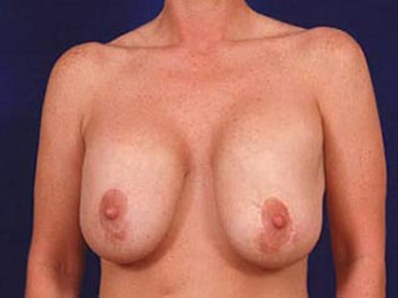Breast Revision by Dr. Wilder Before & After Gallery - Patient 55455356 - Image 1
