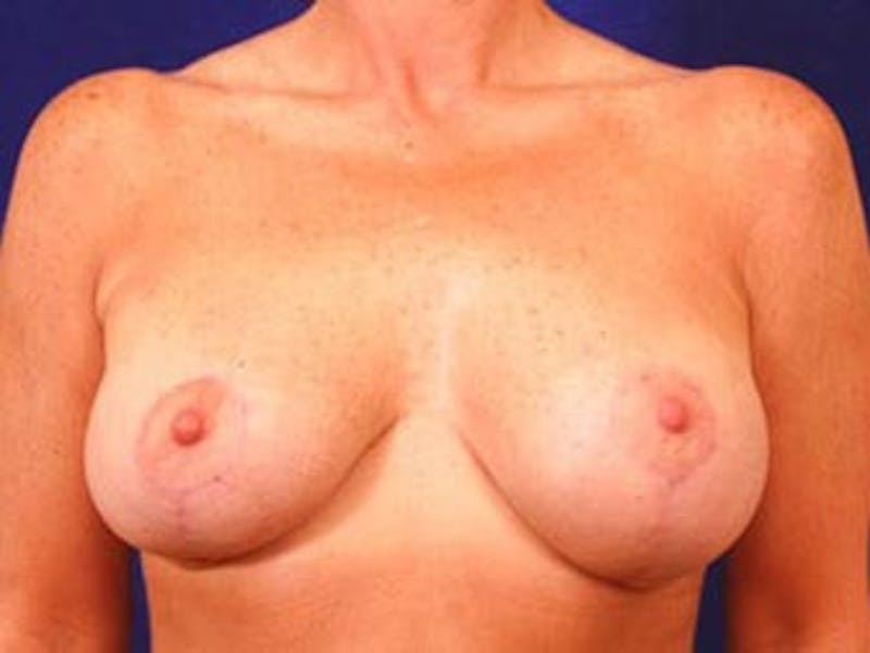 Breast Revision by Dr. Wilder Before & After Gallery - Patient 55455356 - Image 2