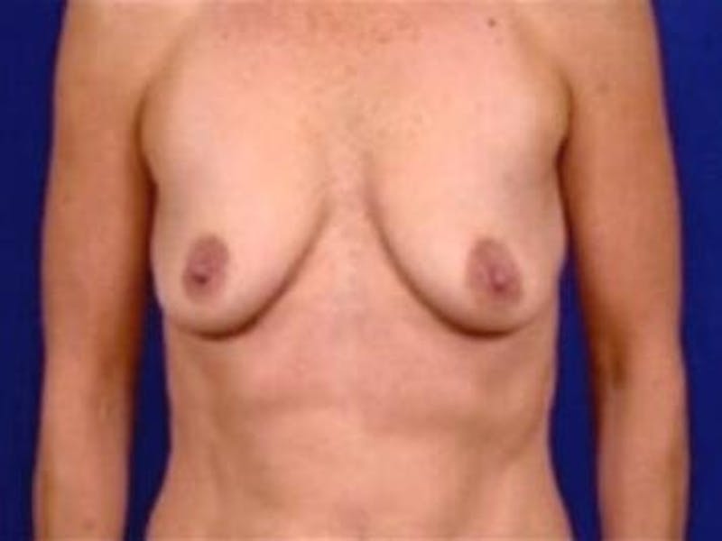 Breast Augmentation by Dr. Wilder Before & After Gallery - Patient 55455359 - Image 1