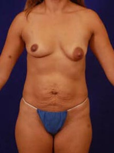 Liposuction by Dr. Wilder Before & After Gallery - Patient 55455360 - Image 1