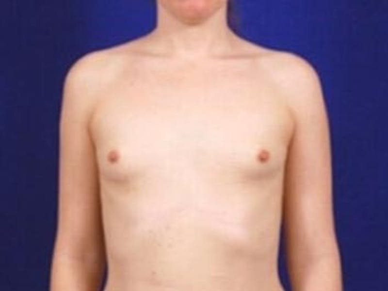 Breast Augmentation by Dr. Wilder Before & After Gallery - Patient 55455361 - Image 1