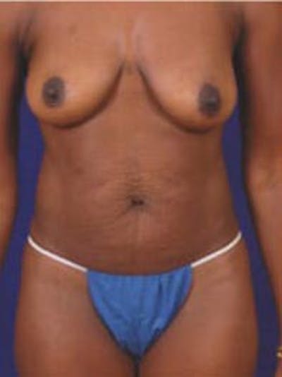 Liposuction by Dr. Wilder Before & After Gallery - Patient 55455362 - Image 1
