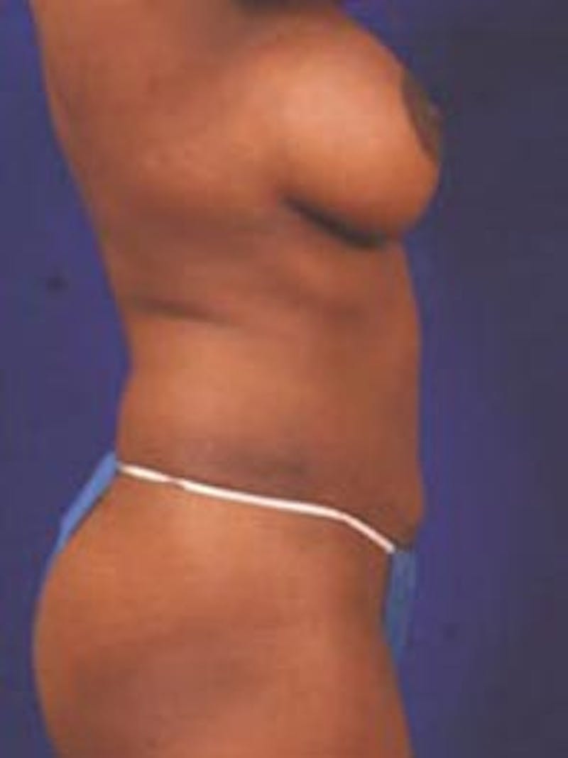 Liposuction by Dr. Wilder Before & After Gallery - Patient 55455362 - Image 4