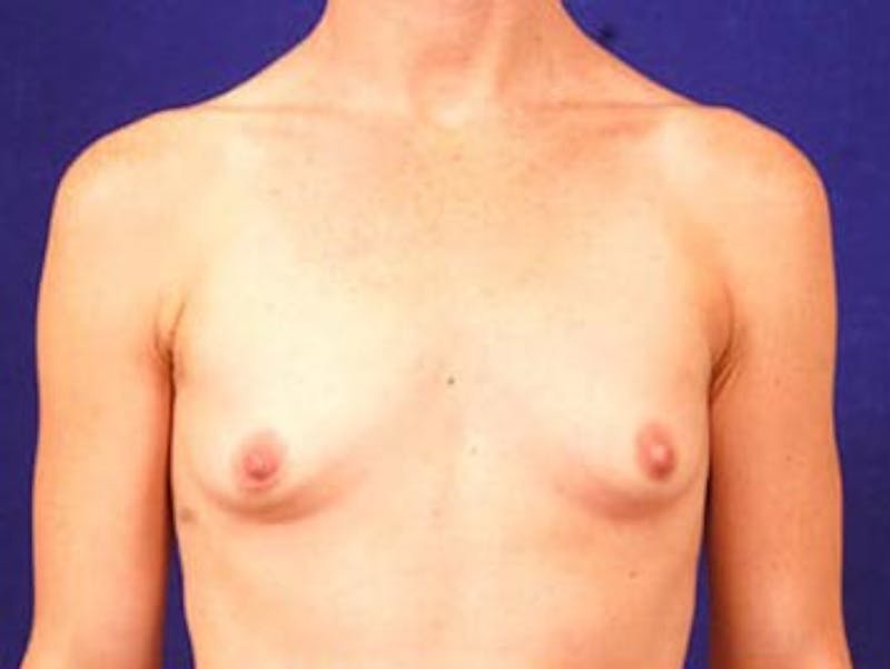 Breast Augmentation by Dr. Wilder Before & After Gallery - Patient 55455364 - Image 1
