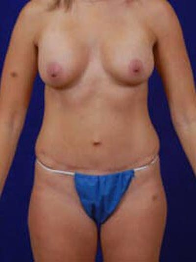 Liposuction by Dr. Wilder Before & After Gallery - Patient 55455366 - Image 2