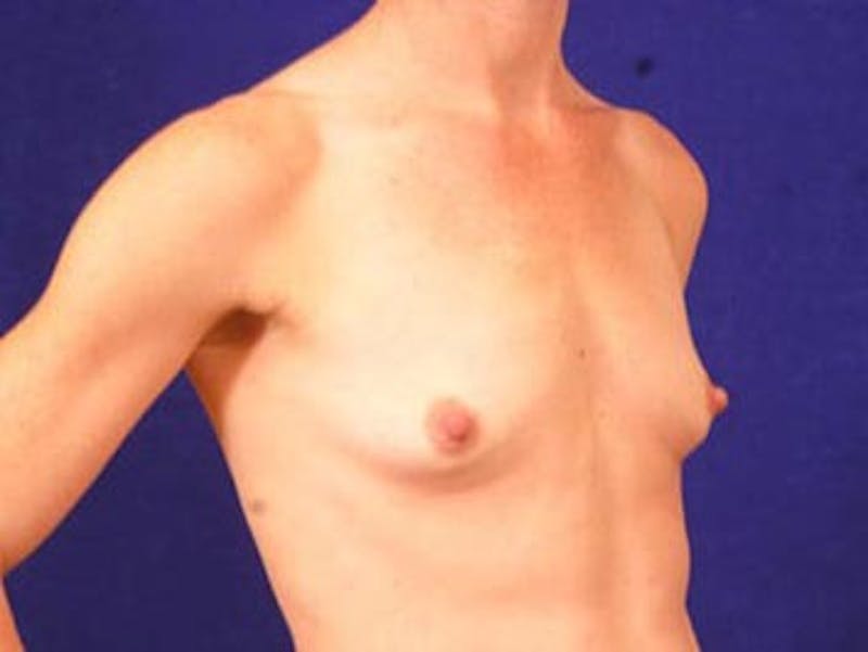 Breast Augmentation by Dr. Wilder Before & After Gallery - Patient 55455364 - Image 3