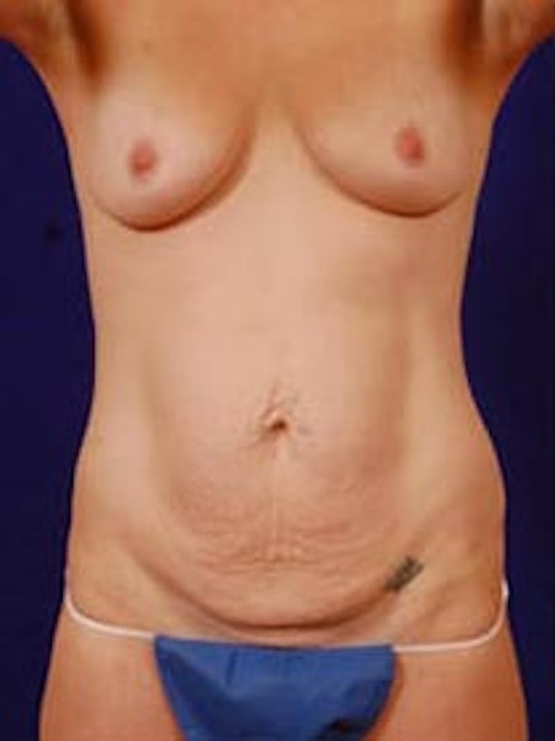 Tummy Tuck by Dr. Wilder Before & After Gallery - Patient 55455370 - Image 1