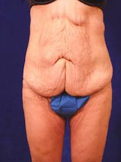 After Weight Loss Surgery by Dr. Wilder Before & After Gallery - Patient 55455373 - Image 1