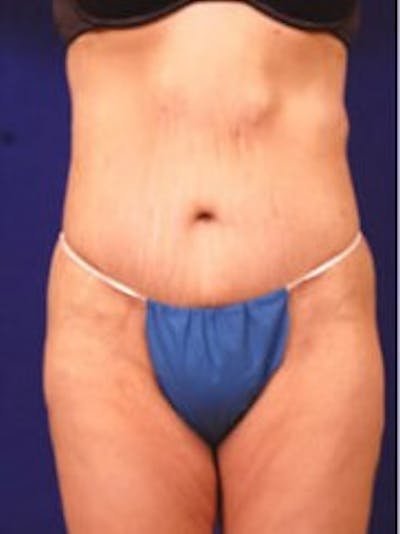 After Weight Loss Surgery by Dr. Wilder Gallery - Patient 55455373 - Image 2