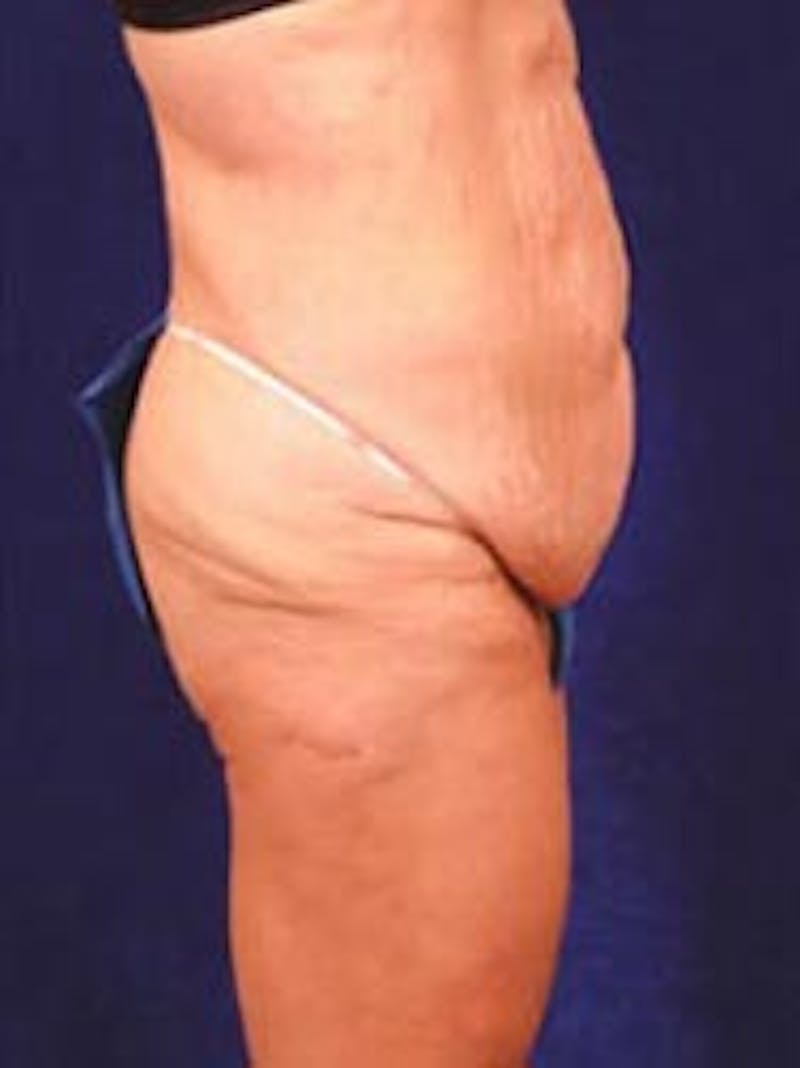 After Weight Loss Surgery by Dr. Wilder Before & After Gallery - Patient 55455373 - Image 3