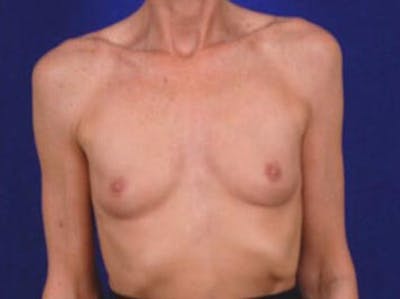 Breast Augmentation by Dr. Wilder Before & After Gallery - Patient 55455374 - Image 1