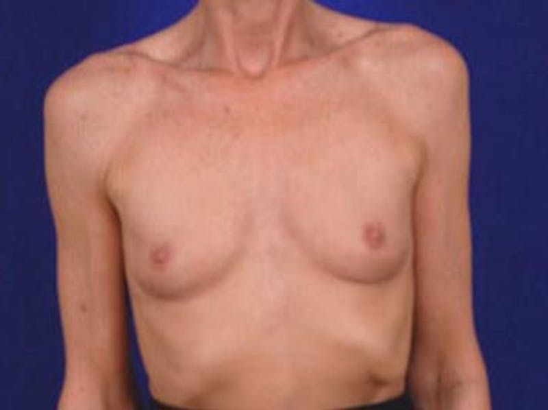 Breast Augmentation by Dr. Wilder Gallery - Patient 55455374 - Image 1