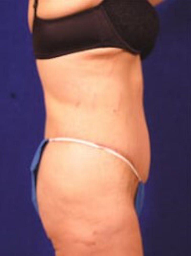 After Weight Loss Surgery by Dr. Wilder Gallery - Patient 55455373 - Image 4