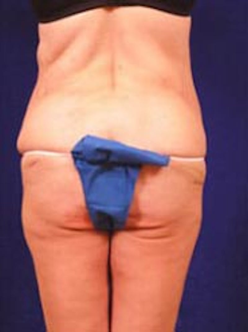 After Weight Loss Surgery by Dr. Wilder Before & After Gallery - Patient 55455373 - Image 5